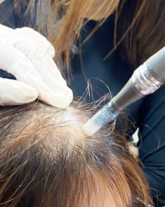Volupropol™ Full Hair Therapy with Microneedling